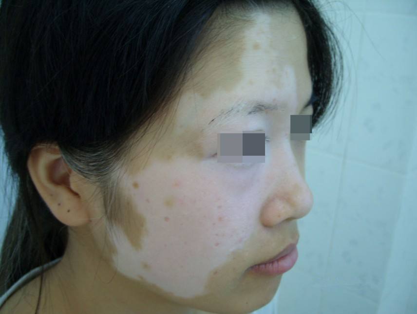 泛发型白癜风应该如何治疗